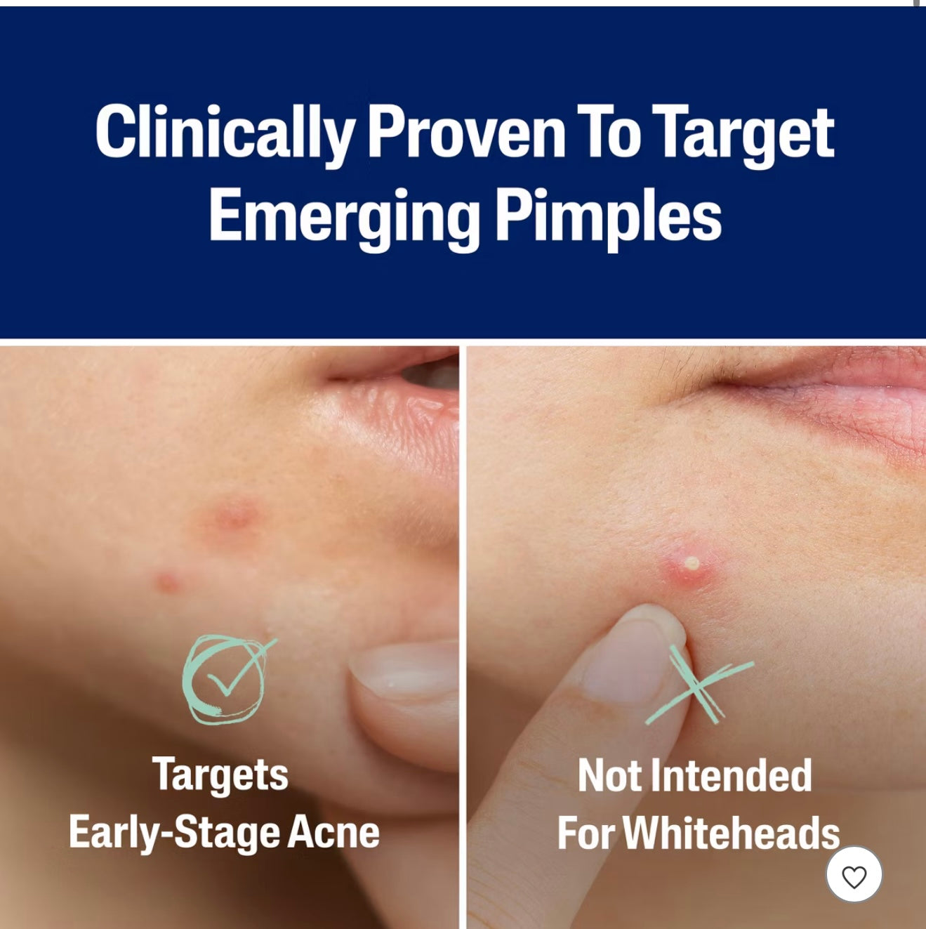 Cetaphil Acne Spot Pimple Patches with Salicylic Acid - 24ct