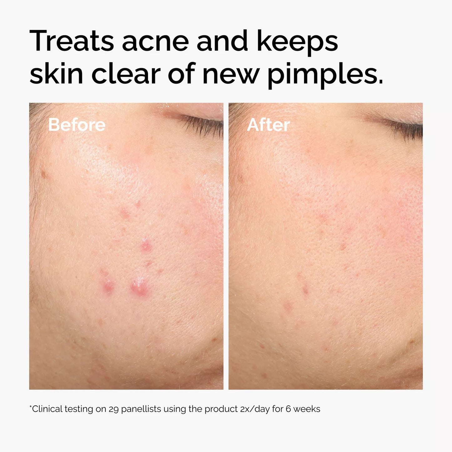 The Ordinary Salicylic Acid 2% Solution, Exfoliating Serum for Acne