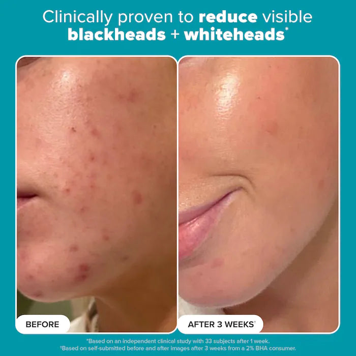 Paula's Choice 
Skin Perfecting 2% BHA Exfoliating Toner for Clear Skin 118ml