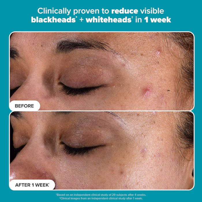 Paula's Choice 
Skin Perfecting 2% BHA Exfoliating Toner for Clear Skin 118ml